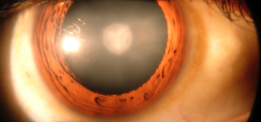 Catarac